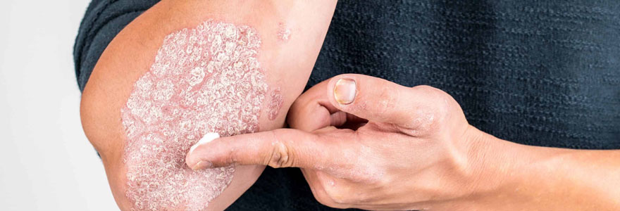 Crème psoriasis