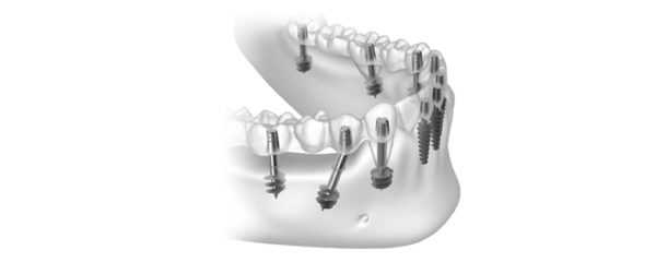 implants basals