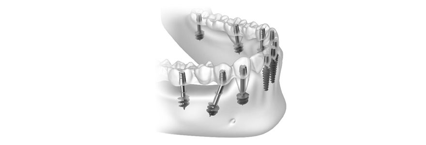 implants basals